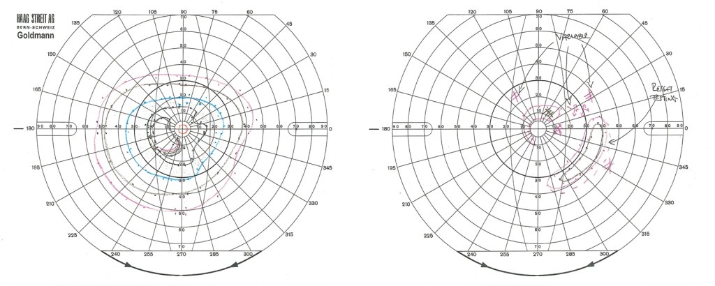 Image of the diagrams from photographer's left and right eye visual field tests.